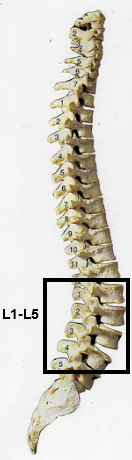 L1-L5 spinal cord injury