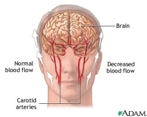 normal abnormal blood flow to brain