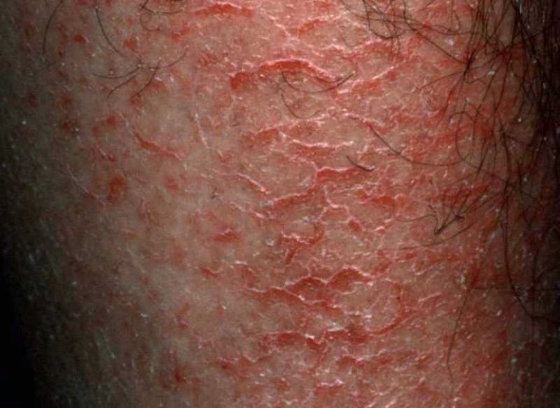 Can Dry Skin Lead To Itching