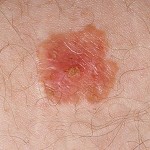 pictures of skin cancer