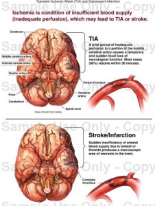 Transient-ischemic-attack