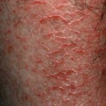 dry cracked skin